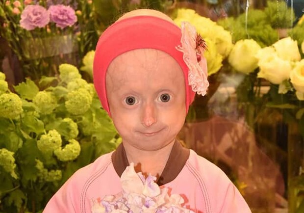 Померла 10-річна Іринка Химич, яка хворіла на рідкісну недугу. Фото: Irina Melentieva