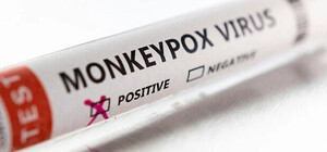 В Україні зафіксували третій випадок віспи мавп