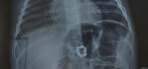 Лікарі Охматдиту врятували хлопчика, який проковтнув магніти та місяць жив з ними