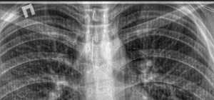 На Одещині лікарі витягли із трахеї підлітка голку