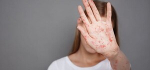 У соцмережах поширюють фейк про спалах кору в Одесі