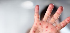 Понад  200 захворілих: на Яворівському полігоні — масштабний спалах кору