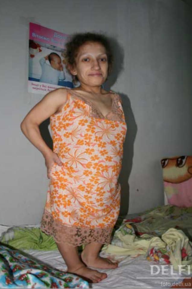 Найнижча мама в Україні Марія Українець із Червонограда потребує допомоги.