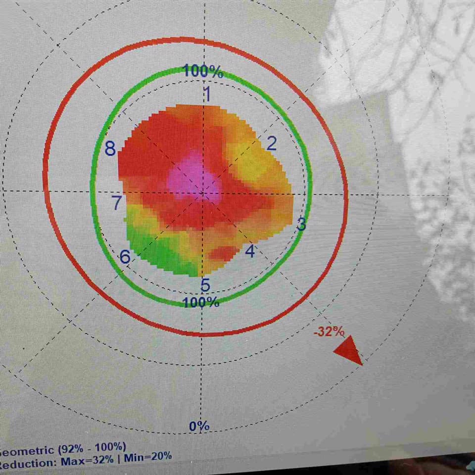 Дослідження каштана на площі Ринок арботомом дало дуже невтішні висновки