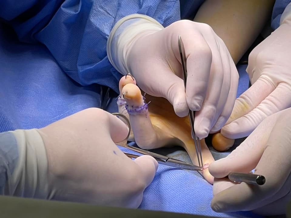 У Львові прооперували п'ятирічну дівчинку, яка народилася з шістьма пальцями.