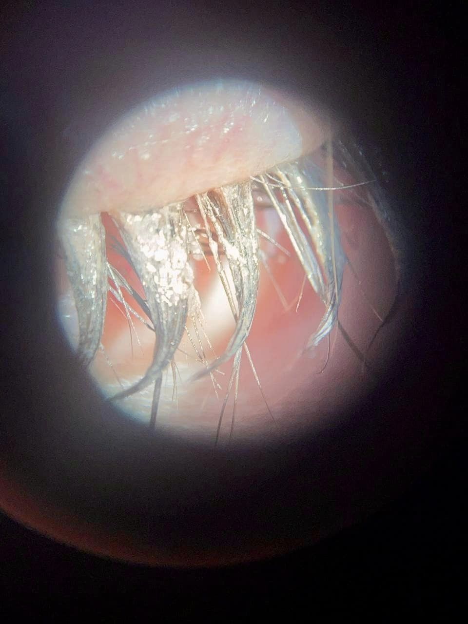 17-річна дівчина з Львівщини втратила вії після нарощення штучних.