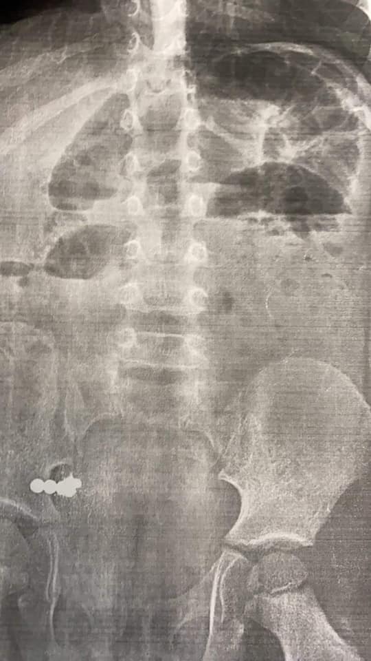 У львівському ОХМАТДИТі хірурги дістали магнітики з кишківника 4-річної дитини. Фото: ОХМАТДИТ