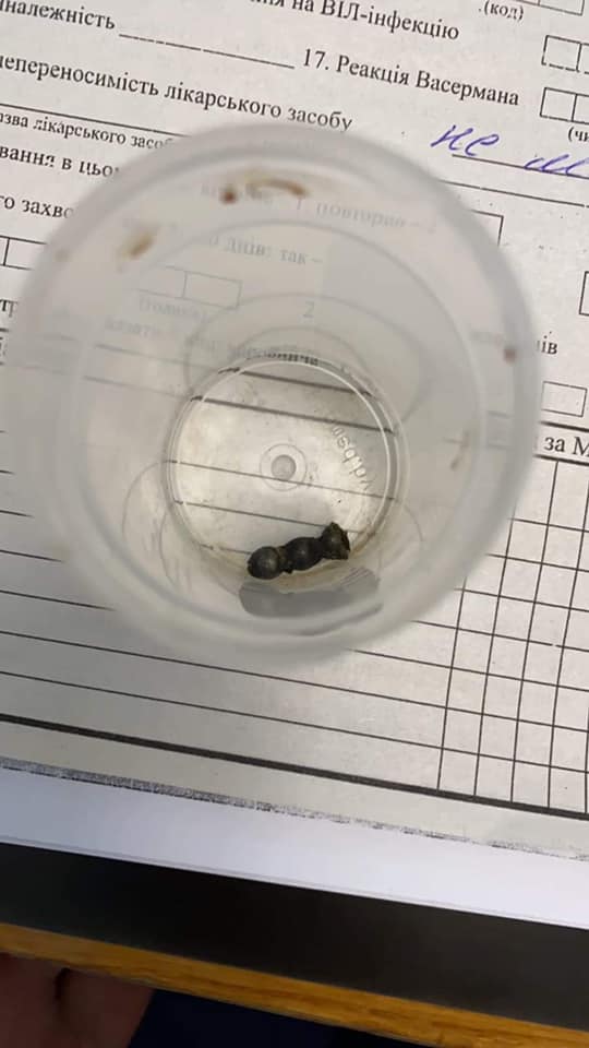 У львівському ОХМАТДИТі хірурги дістали магнітики з кишківника 4-річної дитини. Фото: ОХМАТДИТ