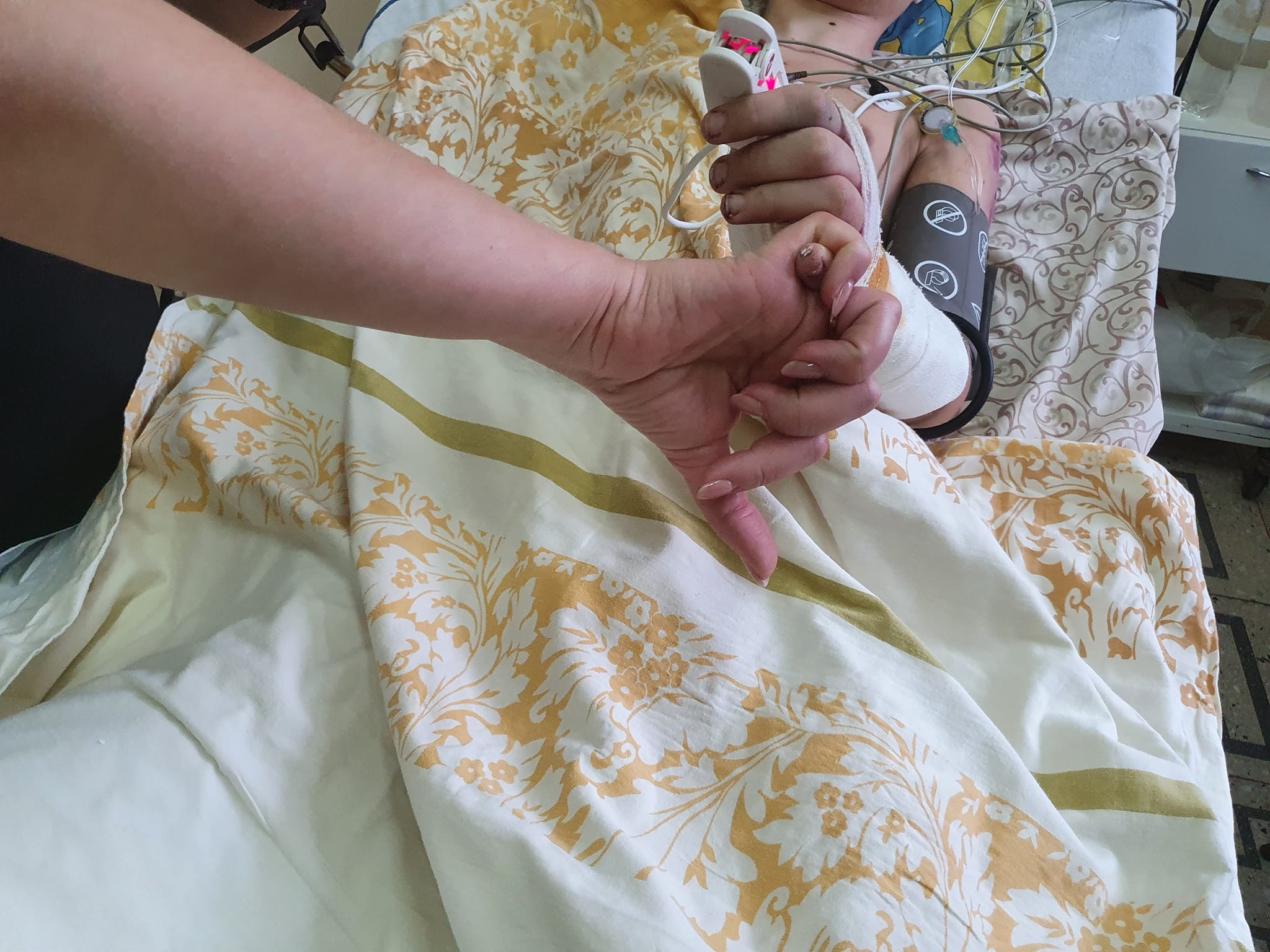 У львівській лікарні ОХМАТДИТ прооперували двох хлопчиків з Маріуполя