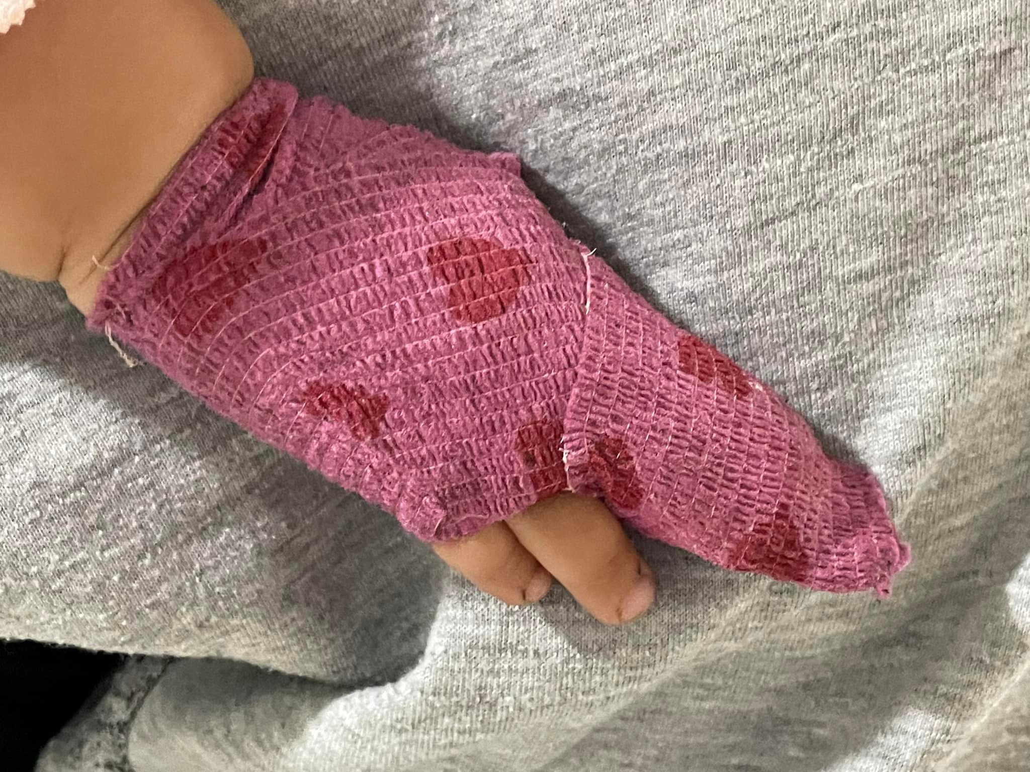 У львівську лікарню потрапила 1,5-річна дівчинка, якій кролик відкусив частину пальчика