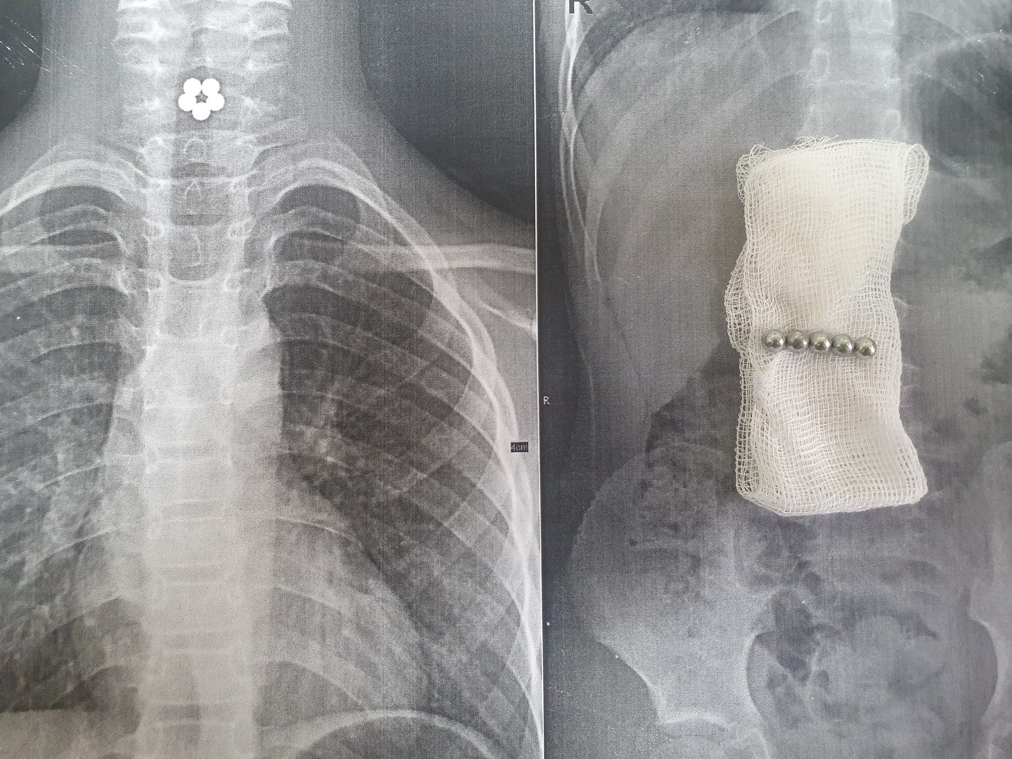 7-річна львів'янка проковтнула п’ять магнітиків