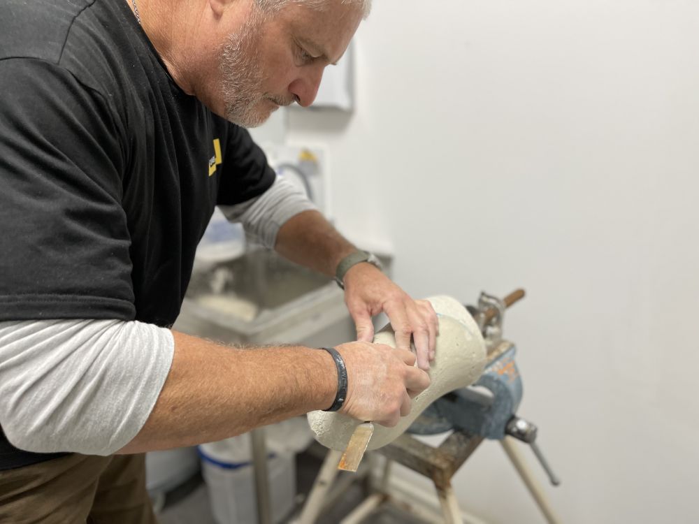 У львівській лікарні виготовили і встановили протез за чотири години