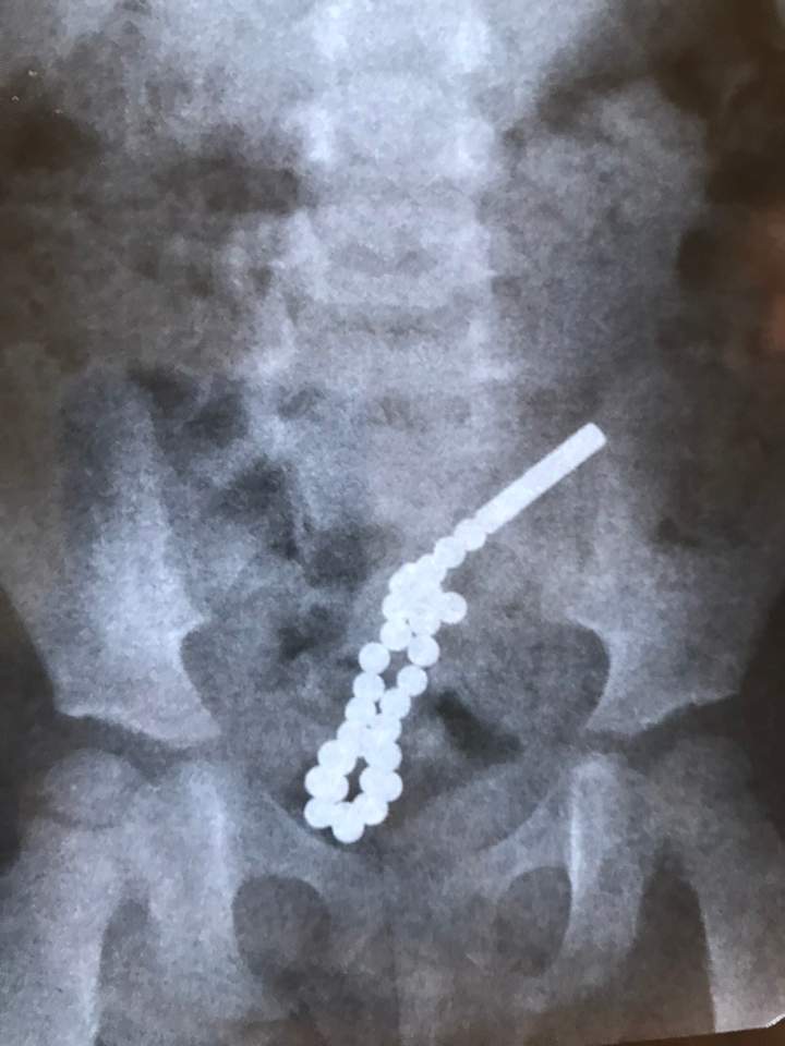 Дворічна львів&rsquo;янка проковтнула 31 намагнічену кульку. Фото лікарів