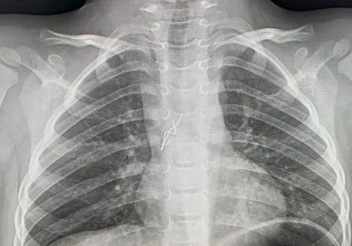 У Львові 4-річний хлопчик проковтнув лампочку з гірлянди