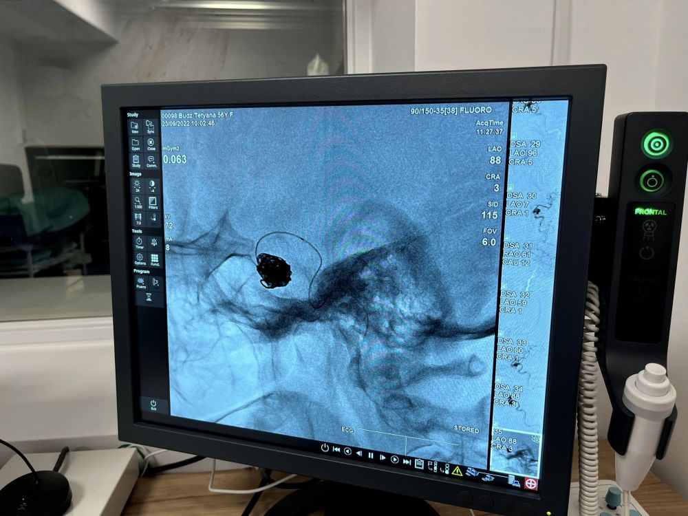 У львівській лікарні прооперували жінку з великою аневризмою мозкової артерії