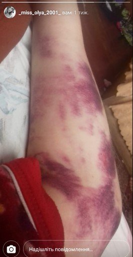 Руки дівчини повністю вкрились синцями. Фото: Єрмоченко Володимир