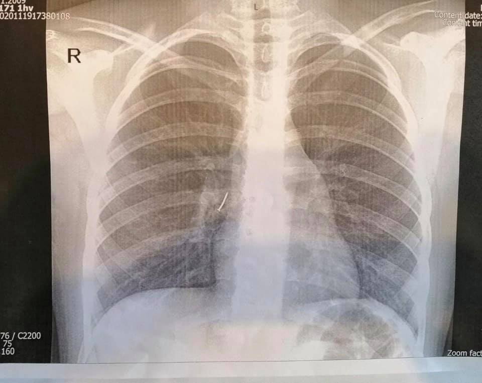 В львівській лікарні прооперували 11-річну дівчину, яка вдихнула цвях. Фото ОХМАТДИТу