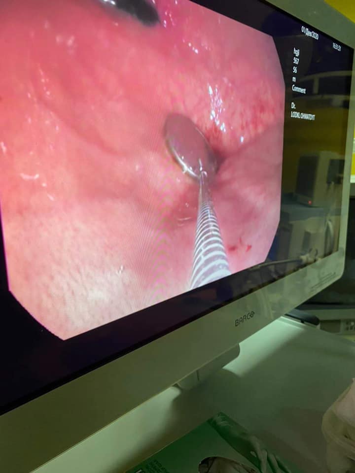 Львівські лікарі дістали зі шлунку 5-річної дитини монету. Фото ОХМАТДИТу