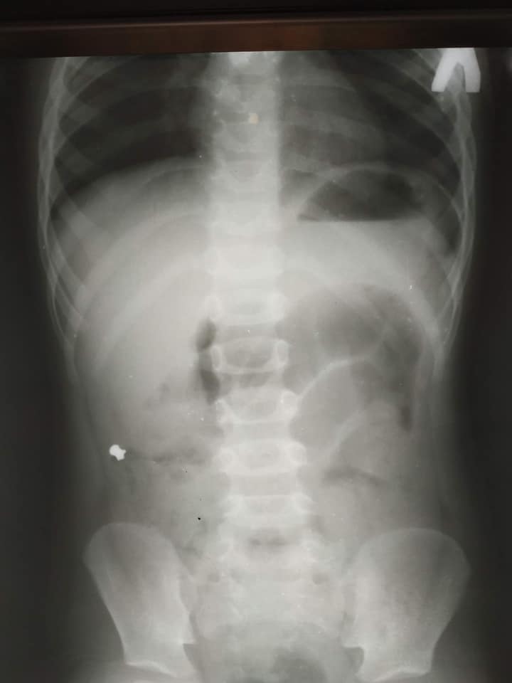 Львівські лікарі прооперували 6-річного хлопчика. Фото ОХМАТДИТу