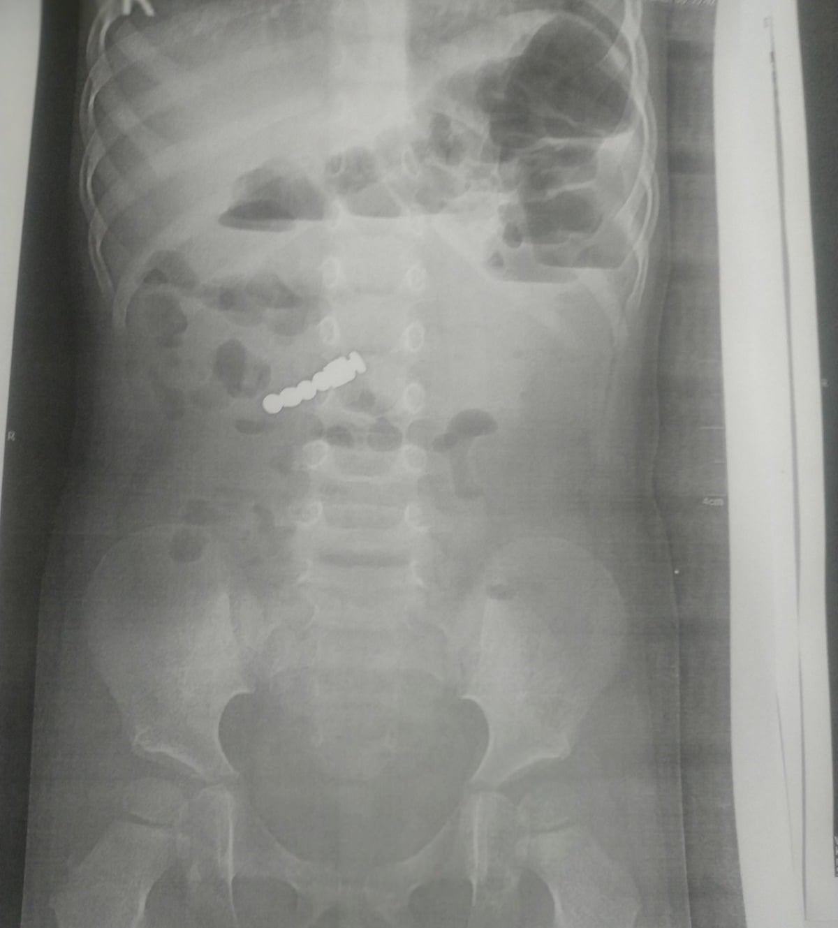 Львівські лікарі врятували 2-річну дівчинку, яка наковталася магнітів