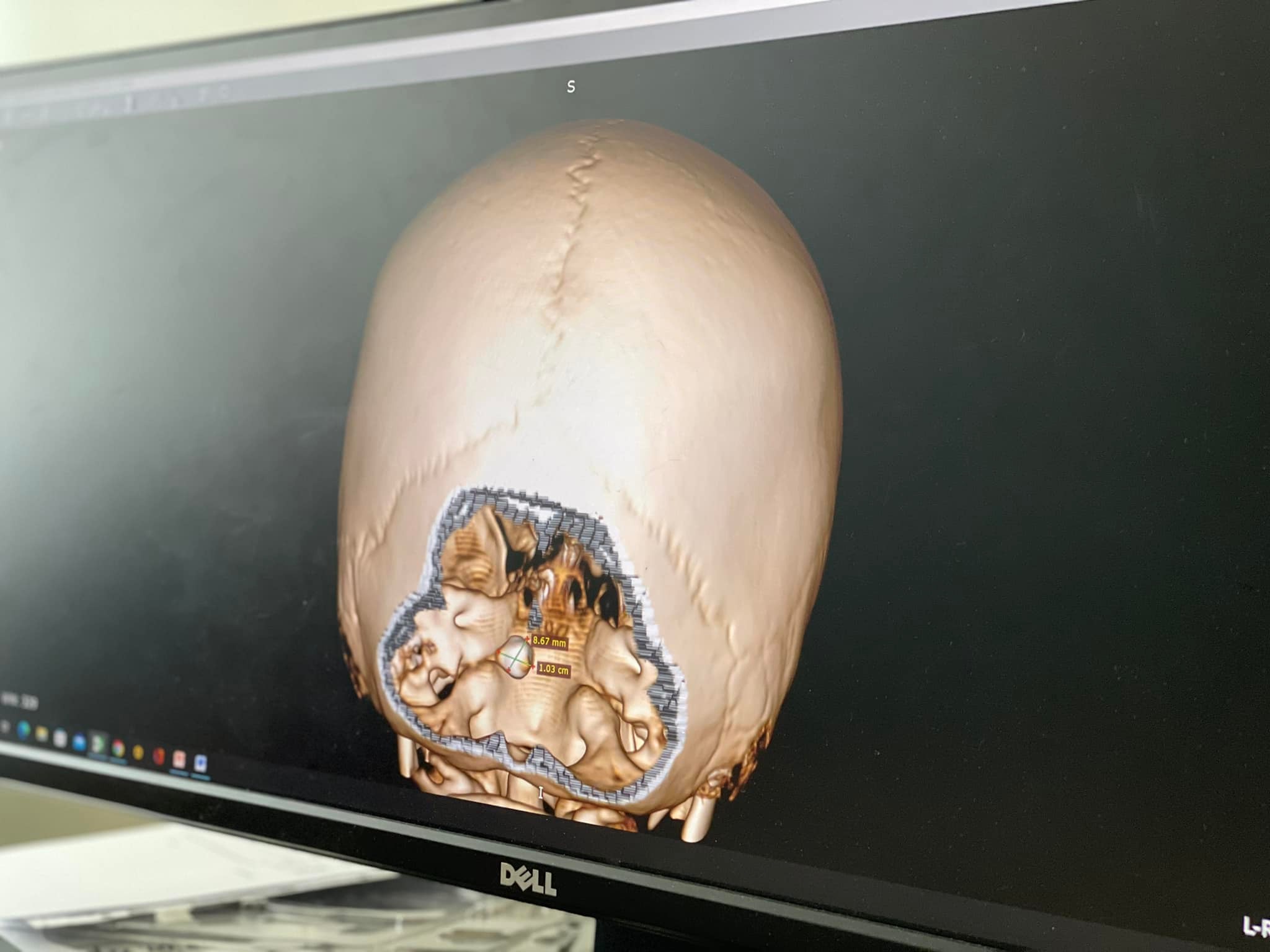 У львівській лікарні врятували 9-річну Софійку, якій крізь мозок пройшов уламок касетного снаряду