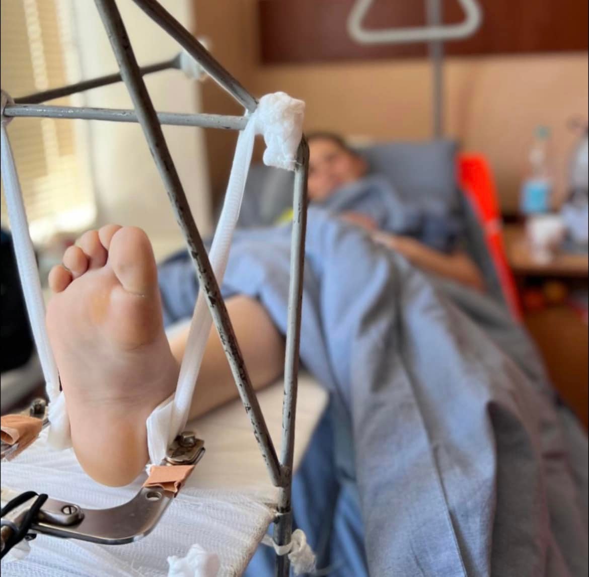 Через падіння з електросамоката львів&rsquo;янка мінімум три місяці не зможе ходити