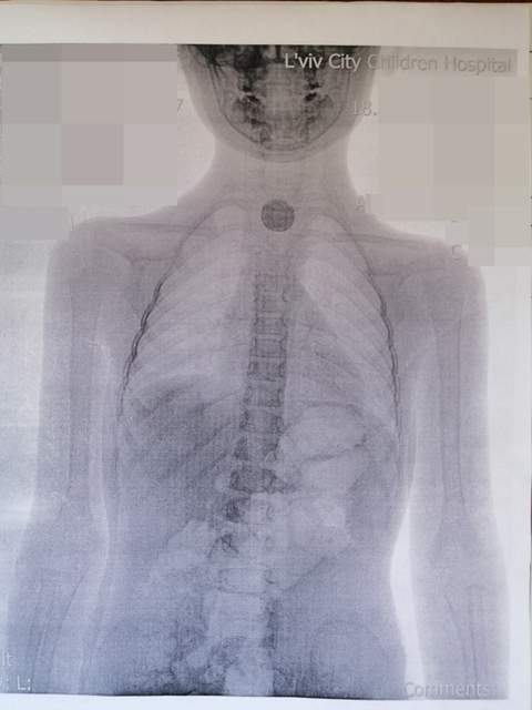 Небезпечні ігри: львівські лікарі дістали зі стравоходу 5-річної дівчинки батарейку фото 1