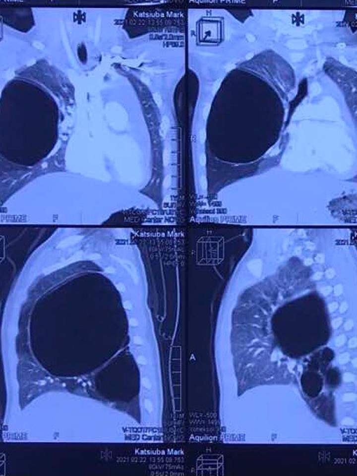 Кіста значно збільшилась. Фото: Zaxid.net